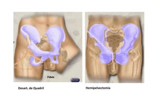 Figura
Desart. de Quadril Hemipelvectomia
 