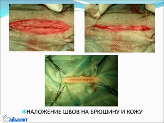 НАЛОЖЕНИЕ ШВОВ НА БРЮШИНУ И КОЖУ
 