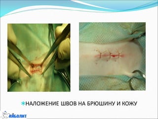 НАЛОЖЕНИЕ ШВОВ НА БРЮШИНУ И КОЖУ
 