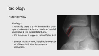 Ankle Fractures.pptx