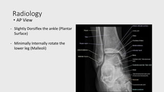 Ankle Fractures.pptx