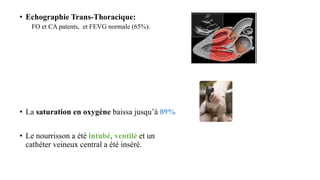 • Echographie Trans-Thoracique:
FO et CA patents, et FEVG normale (65%).
• La saturation en oxygène baissa jusqu’à 89%
• Le nourrisson a été intubé, ventilé et un
cathéter veineux central a été inséré.
 