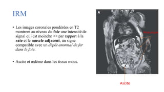 IRM
• Les images coronales pondérées en T2
montrent au niveau du foie une intensité de
signal qui est moindre << par rapport à la
rate et le muscle adjacent, un signe
compatible avec un dépôt anormal de fer
dans le foie.
• Ascite et œdème dans les tissus mous.
Ascite
Anasarque
 