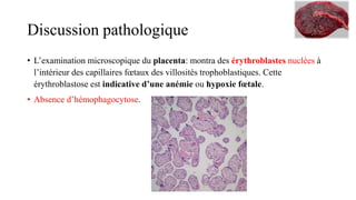 Discussion pathologique
• L’examination microscopique du placenta: montra des érythroblastes nuclées à
l’intérieur des capillaires fœtaux des villosités trophoblastiques. Cette
érythroblastose est indicative d’une anémie ou hypoxie fœtale.
• Absence d’hémophagocytose.
 
