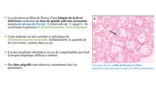 • La coloration au Bleu de Prusse d’une biopsie de la lèvre
inférieure contenant du tissu de glande salivaire accessoire
montra un niveau de Fer de +2 (intervalle de +1 jusqu’à +4),
confirmant la présence d’hémochromatose extra-hépatique.
• Cette méthode est très sensible et spécifique de
l'hémochromatose néonatale. Généralement, la quantité de
fer est minime, comme dans ce cas.
• Est une excellente alternative en cas de coagulopathie qui rend
la biopsie hépatique difficile à réaliser.
• Des faux négatifs sont observés, notamment chez les
prématurés.
Coloration du Fer au Bleu de Prusse (de Perls),
montrant la deposition du Fer dans les cellules glandulaires
 