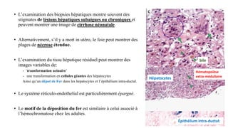 • L’examination des biopsies hépatiques montre souvent des
stigmates de lésions hépatiques subaigues ou chroniques et
peuvent montrer une image de cirrhose néonatale.
• Alternativement, s’il y a mort in utéro, le foie peut montrer des
plages de nécrose étendue.
• L’examination du tissu hépatique résiduel peut montrer des
images variables de:
- ‘transformation acinaire’
- une transformation en cellules géantes des hépatocytes
Ainsi qu’un dépot de Fer dans les hepatocytes et l’épithélium intra-ductal.
• Le système réticulo-endothelial est particulièrement épargné.
• Le motif de la déposition du fer est similaire à celui associé à
l’hémochromatose chez les adultes.
Épithélium intra-ductal:
Hépatocytes
bile
Hématopoïèse
extra-médullaire
 