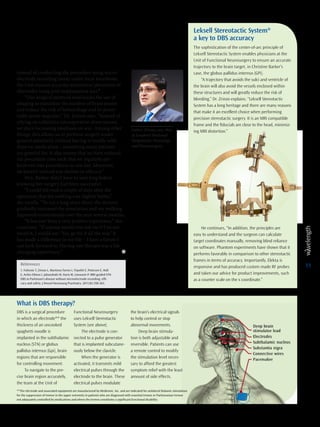11
instead of conducting the procedure using micro-
electrode recording (mer) under local anesthesia,
the Unit ensures accurate anatomical placement of
electrodes using post-implantation mri.1
“Our surgical protocol maximizes the use of
imaging to minimize the number of brain passes
and reduce the risk of hemorrhage and its poten-
tially severe sequalae,” Dr. Zrinzo says. “Instead of
relying on subjective intraoperative observations,
we place increasing emphasis on mri. Among other
things, this allows us to perform surgery under
general anesthetic without having to totally with-
draw pd medication – something many patients
are grateful for. It also means that we have reduced
the procedure time such that we regularly per-
form two dbs procedures in one day. Moreover,
we haven’t noticed any decline in efficacy.”
Mrs. Barker didn’t have to wait long before
knowing her surgery had been successful.
“I could tell even a couple of days after the
operation that my walking was slightly better,”
she recalls. “To cut a long story short, the doctors
gradually increased the simulation and my walking
improved tremendously over the next several months.
“It has just been a very positive experience,” she
continues. “If anyone would ever ask me if I recom-
mend it, I would say: ‘Yes, go for it all the way.’ It
has made a difference in my life – I have a future I
can look forward to. Having dbs therapy was a life
changing experience.” l
References
1. Foltynie T, Zrinzo L, Martinez-Torres I, Tripoliti E, Petersen E, Holl
E, Aviles-Olmos I, Jahanshahi M, Hariz M, Limousin P. MRI-guided STN
DBS in Parkinson’s disease without microelectrode recording: effi-
cacy and safety. J Neurol Neurosurg Psychiatry. 2011;82:358-363.
Ludvic Zrinzo, md, phd,
at London’s National
Hospital for Neurology
and Neurosurgery
Leksell Stereotactic System®
a key to DBS accuracy
The sophistication of the center-of-arc principle of
Leksell Stereotactic System enables physicians at the
Unit of Functional Neurosurgery to ensure an accurate
trajectory to the brain target, in Christine Barker’s
case, the globus pallidus internus (GPi).
“A trajectory that avoids the sulci and ventricle of
the brain will also avoid the vessels enclosed within
these structures and will greatly reduce the risk of
bleeding,” Dr. Zrinzo explains. “Leksell Stereotactic
System has a long heritage and there are many reasons
that make it an excellent choice when performing
precision stereotactic surgery. It is an MRI compatible
frame and the fiducials are close to the head, minimiz-
ing MRI distortion.”
He continues, “In addition, the principles are
easy to understand and the surgeon can calculate
target coordinates manually, removing blind reliance
on software. Phantom experiments have shown that it
performs favorably in comparison to other stereotactic
frames in terms of accuracy. Importantly, Elekta is
responsive and has produced custom made RF probes
and taken our advice for product improvements, such
as a counter scale on the x coordinate.”
What is DBS therapy?
DBS is a surgical procedure
in which an electrode** the
thickness of an uncooked
spaghetti noodle is
implanted in the subthalamic
nucleus (STN) or globus
pallidus internus (Gpi), brain
regions that are responsible
for controlling movement.
To navigate to the pre-
cise brain region accurately,
the team at the Unit of
Functional Neurosurgery
uses Leksell Stereotactic
System (see above).
The electrode is con-
nected to a pulse generator
that is implanted subcutane-
ously below the clavicle.
When the generator is
activated, it transmits mild
electrical pulses through the
electrode to the brain. These
electrical pulses modulate
the brain’s electrical signals
to help control or stop
abnormal movements.
Deep brain stimula-
tion is both adjustable and
reversible. Patients can use
a remote control to modify
the stimulation level neces-
sary to afford the greatest
symptom relief with the least
amount of side effects.
**The electrode and associated equipment are manufactured by Medtronic, Inc. and are indicated for unilateral thalamic stimulation
for the suppression of tremor in the upper extremity in patients who are diagnosed with essential tremor or Parkinsonian tremor
not adequately controlled by medications and where the tremor constitutes a significant functional disability.
 