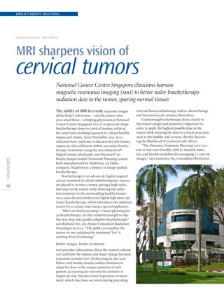 16
GYNECOLOGICAL TREATMENT
MRI sharpens vision of
cervical tumors
National Cancer Centre Singapore clinicians harness
magnetic resonance imaging (mri) to better tailor brachytherapy
radiation dose to the tumor, sparing normal tissues
The ability of MRI to create exquisite images
of the body’s soft tissues – and the tumors that
arise amid them – is helping physicians at National
Cancer Centre Singapore (nccs) to precisely shape
brachytherapy doses to cervical tumors, while at
the same time avoiding exposure to critical healthy
organs and tissues. Since November 2011, nccs
clinicians have used mri to characterize soft tissues,
organs-at-risk and lesions before successive brachy-
therapy treatments using the microSelectron®
Digital remote afterloader and Oncentra® 3d
Brachy Image Guided Treatment Planning system,
both manufactured by Nucletron, an Elekta
company. Nucletron is a pioneer in image-guided
brachytherapy.
Brachytherapy is an advanced, highly targeted
cancer treatment in which radiotherapeutic sources
are placed in or near a tumor, giving a high radia-
tion dose to the tumor while reducing the radia-
tion exposure in the surrounding healthy tissues.
nccs uses the microSelectron Digital high dose rate
(hdr) brachytherapy, which introduces the radiation
source for a certain time using a special applicator.
“After our first year using ct based planning for
3d brachytherapy, we felt confident enough to take
the next step: mri guided adaptive brachytherapy,”
says Richard Yeo, md, Senior Consultant Radiation
Oncologist at nccs. “The ability to visualize the
tumor on mri and plan the treatment ‘live’ is
nothing short of amazing.”
Better images, better treatment
mri provides information about the tumor’s volume
(3d) and how the volume and shape change between
treatment sessions (4d). Performing an mri scan
before each brachy session enables clinicians to
adapt the dose to the unique anatomy of each
patient, accounting for not only the position of
organs-at-risk, but also tumor regression or move-
ment, which may have occurred during preceding
external beam radiotherapy and/or chemotherapy
and between brachy sessions themselves.
Conforming brachytherapy doses closely to
the tumor’s shape and position is important in
order to apply the highest possible dose to the
tumor while limiting the dose to critical structures
such as the bladder and rectum, thereby decreas-
ing the likelihood of treatment side effects.
“The Oncentra Treatment Planning (otp) sys-
tem is very user friendly, with its intuitive inter-
face and flexible workflow for managing ct and mr
images,” says Lawrence Ng, Consultant Physicist at
BRACHYTHERAPY SOLUTIONS
 