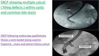 ERCP showing multiple calculi
( filling defects ) within cystic
and common bile ducts
ERCP following endoscopy papillotomy
Shows a wire basket being used to
fragment , snare and extract biliary calculi
 