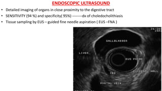 ENDOSCOPIC ULTRASOUND
• Detailed imaging of organs in close proximity to the digestive tract
• SENSITIVITY (94 %) and specificity( 95%) --------dx of choledocholithiasis
• Tissue sampling by EUS – guided fine needle aspiration ( EUS –FNA )
 