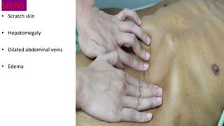 SIGNS
• Scratch skin
• Hepatomegaly
• Dilated abdominal veins
• Edema
 