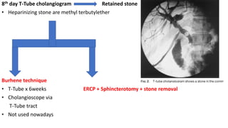 8th day T-Tube cholangiogram Retained stone
• Heparinizing stone are methyl terbutylether
Burhene technique
• T-Tube x 6weeks ERCP + Sphincterotomy + stone removal
• Cholangioscope via
T-Tube tract
• Not used nowadays
 