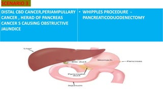 SCENARIO 3
DISTAL CBD CANCER,PERIAMPULLARY
CANCER , HERAD OF PANCREAS
CANCER S CAUSING OBSTRUCTIVE
JAUNDICE
• WHIPPLES PROCEDURE -
PANCREATICODUODENECTOMY
 