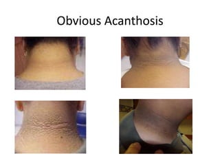 Obvious Acanthosis
 