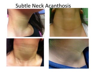 Subtle Neck Acanthosis
 