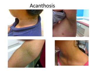 Acanthosis
 