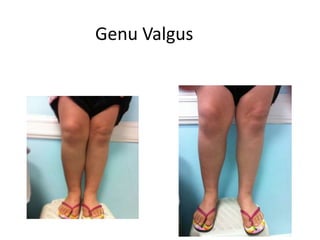 Genu Valgus
 