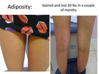 Adiposity: Gained and lost 20 lbs in a couple
of months
 