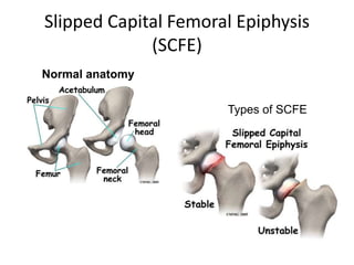 Slipped Capital Femoral Epiphysis
(SCFE)
Normal anatomy
Types of SCFE
 