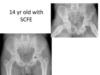 14 yr old with
SCFE
 