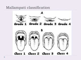 Mallampati classification
 