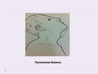 Thyromental distance
 