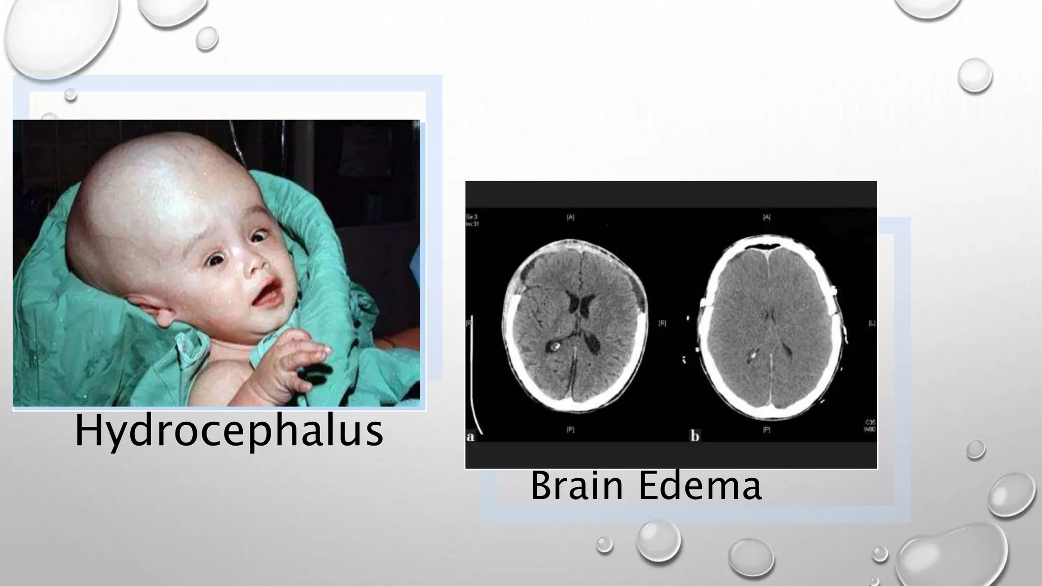 Hydrocephalus
Brain Edema
 