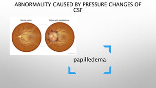 ABNORMALITY CAUSED BY PRESSURE CHANGES OF
CSF
papilledema
 