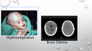 Hydrocephalus
Brain Edema
 