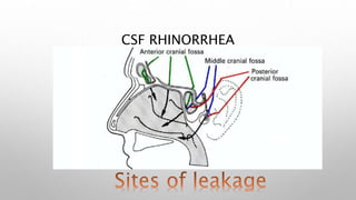 CSF RHINORRHEA
 