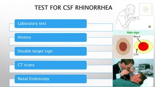 TEST FOR CSF RHINORRHEA
Laboratory test
History
Double target sign
CT scans
Nasal Endoscopy
 