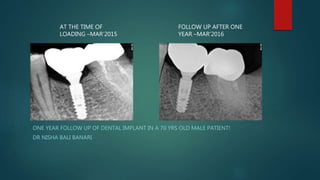 ONE YEAR FOLLOW UP OF DENTAL IMPLANT IN A 70 YRS OLD MALE PATIENT!
DR NISHA BALI BANARI
AT THE TIME OF
LOADING –MAR’2015
FOLLOW UP AFTER ONE
YEAR –MAR’2016
 