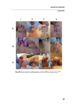 REVIEW OF LITERATURE
Hypospadias
34
Fig. [9] Representative photographs of the GMS scoring criteria [21]
.
 