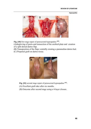 REVIEW OF LITERATURE
Hypospadias
46
Fig. [10] first stage repair of penoscrotal hypospadias [41]
.
(A)degloving of penis and transection of the urethral plate and creation
of a split dorsal dartos flap.
(B) Transposition of the flaps ventrally creating a paramedian dartos bed.
(C) Preputial graft on dartos tissue.
Fig. [11] second stage repair of penoscrotal hypospadias [41]
.
(A) Excellent graft take after six months.
(B) Outcome after second stage using a 4-layer closure.
 