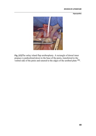 REVIEW OF LITERATURE
Hypospadias
49
Fig. [12]The onlay island flap urethroplasty. A rectangle of dorsal inner
prepuce is pediculized down to the base of the penis, transferred to the
ventral side of the penis and sutured to the edges of the urethral plate [36]
.
 