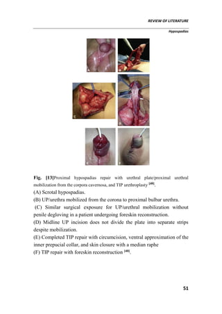 REVIEW OF LITERATURE
Hypospadias
51
Fig. [13]Proximal hypospadias repair with urethral plate/proximal urethral
mobilization from the corpora cavernosa, and TIP urethroplasty [40]
.
(A) Scrotal hypospadias.
(B) UP/urethra mobilized from the corona to proximal bulbar urethra.
(C) Similar surgical exposure for UP/urethral mobilization without
penile degloving in a patient undergoing foreskin reconstruction.
(D) Midline UP incision does not divide the plate into separate strips
despite mobilization.
(E) Completed TIP repair with circumcision, ventral approximation of the
inner prepucial collar, and skin closure with a median raphe
(F) TIP repair with foreskin reconstruction [40]
.
 