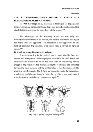 REVIEW OF LITERATURE
Hypospadias
52
THE KOYANAGI-NONOMURA ONE-STAGE REPAIR FOR
SEVERE PERINEAL HYPOSPADIAS:
In 1983 Koyanagi et al. innovated a technique for hypospadias
repair, which used parameatal-based flaps that extend distally around the
distal shaft to incorporate the inner layer of the prepuce[29]
.
The advantages of the Koyanagi repair are that only one
anastomosis is necessary at the meatus, and neither torsion nor bulking of
the penile shaft was apparent. This procedure is also applicable to any
kind of proximal hypospadias, even those with a scrotal or perineal
meatus[30]
.
Original Koyanagi Operative technique:
A meatal-based yoke is outlined that extends distally from the
meatus and incorporates the inner prepuce to encircle the shaft. Outer and
inner incisions are used to detach the yoke from all surrounding tissues
except at the region of the meatus. Elements of chordee are corrected
through the outer incision, and the urethral plate is mobilized as needed to
complete chordee repair. The 2 flaps are joined to create the neourethra,
which is then tubularized, brought out to the tip of the glans, and covered
with shaft and scrotal skin to complete the repair[29]
.
Fig. [14] Koyanagi's original technique [29]
.
 
