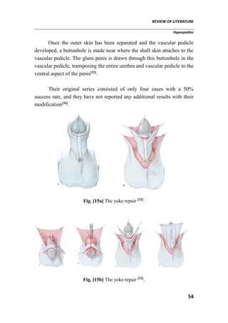REVIEW OF LITERATURE
Hypospadias
54
Once the outer skin has been separated and the vascular pedicle
developed, a buttonhole is made near where the shaft skin attaches to the
vascular pedicle. The glans penis is drawn through this buttonhole in the
vascular pedicle, transposing the entire urethra and vascular pedicle to the
ventral aspect of the penis[32]
.
Their original series consisted of only four cases with a 50%
success rate, and they have not reported any additional results with their
modification[34]
.
Fig. [15a] The yoke repair [32]
.
Fig. [15b] The yoke repair [32]
.
 