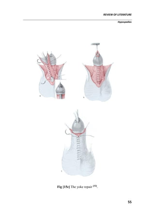 REVIEW OF LITERATURE
Hypospadias
55
Fig [15c] The yoke repair [32]
.
 
