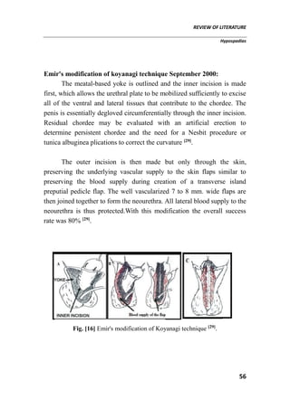 REVIEW OF LITERATURE
Hypospadias
56
Emir's modification of koyanagi technique September 2000:
The meatal-based yoke is outlined and the inner incision is made
first, which allows the urethral plate to be mobilized sufficiently to excise
all of the ventral and lateral tissues that contribute to the chordee. The
penis is essentially degloved circumferentially through the inner incision.
Residual chordee may be evaluated with an artificial erection to
determine persistent chordee and the need for a Nesbit procedure or
tunica albuginea plications to correct the curvature [29]
.
The outer incision is then made but only through the skin,
preserving the underlying vascular supply to the skin flaps similar to
preserving the blood supply during creation of a transverse island
preputial pedicle flap. The well vascularized 7 to 8 mm. wide flaps are
then joined together to form the neourethra. All lateral blood supply to the
neourethra is thus protected.With this modification the overall success
rate was 80% [29]
.
Fig. [16] Emir's modification of Koyanagi technique [29]
.
 
