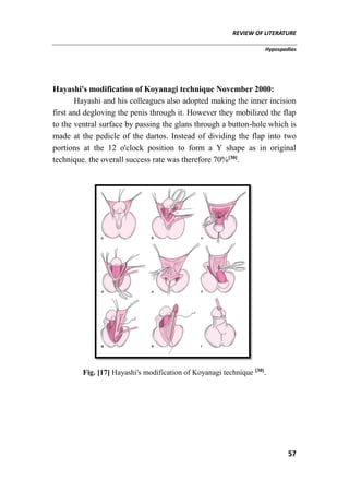 REVIEW OF LITERATURE
Hypospadias
57
Hayashi's modification of Koyanagi technique November 2000:
Hayashi and his colleagues also adopted making the inner incision
first and degloving the penis through it. However they mobilized the flap
to the ventral surface by passing the glans through a button-hole which is
made at the pedicle of the dartos. Instead of dividing the flap into two
portions at the 12 o'clock position to form a Y shape as in original
technique. the overall success rate was therefore 70%[30]
.
Fig. [17] Hayashi's modification of Koyanagi technique [30]
.
 