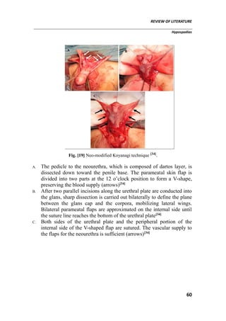 REVIEW OF LITERATURE
Hypospadias
60
Fig. [19] Neo-modified Koyanagi technique [34]
.
A. The pedicle to the neourethra, which is composed of dartos layer, is
dissected down toward the penile base. The parameatal skin flap is
divided into two parts at the 12 o’clock position to form a V-shape,
preserving the blood supply (arrows)[34]
B. After two parallel incisions along the urethral plate are conducted into
the glans, sharp dissection is carried out bilaterally to define the plane
between the glans cap and the corpora, mobilizing lateral wings.
Bilateral parameatal flaps are approximated on the internal side until
the suture line reaches the bottom of the urethral plate[34]
C. Both sides of the urethral plate and the peripheral portion of the
internal side of the V-shaped flap are sutured. The vascular supply to
the flaps for the neourethra is sufficient (arrows)[34]
 