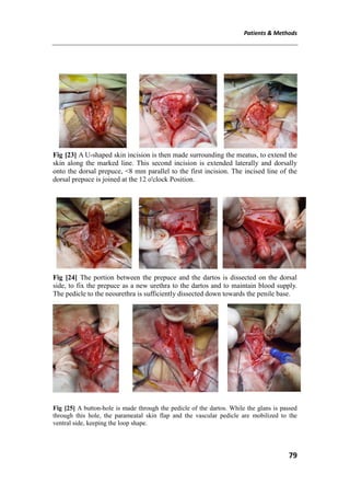 Patients & Methods
79
Fig [23] A U-shaped skin incision is then made surrounding the meatus, to extend the
skin along the marked line. This second incision is extended laterally and dorsally
onto the dorsal prepuce, <8 mm parallel to the first incision. The incised line of the
dorsal prepuce is joined at the 12 o'clock Position.
Fig [24] The portion between the prepuce and the dartos is dissected on the dorsal
side, to fix the prepuce as a new urethra to the dartos and to maintain blood supply.
The pedicle to the neourethra is sufficiently dissected down towards the penile base.
Fig [25] A button-hole is made through the pedicle of the dartos. While the glans is passed
through this hole, the parameatal skin flap and the vascular pedicle are mobilized to the
ventral side, keeping the loop shape.
 