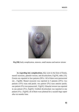 RESULTS
93
Fig [38] Early complication, stenosis, small meatus and narrow stream
As regarding late complications, they were in the form of fistula,
meatal recession, glanular torsion, and diverticulum, Fig[39], table [15].
Fistula was reported in four patients (20%). All of them were penoscrotal
site , Fig[40]. Meatal recession was reported in 5 patients (25%). two
patients (15%) were mid penile. two patient (5%) were anterior penile,
one patient (5%) was penoscrotal , Fig[41]. Glanular torsion was reported
in one patient (5%) ,Fig[42]. Urethral diverticulum was reported in one
patient (5%) , Fig[43]. all of them were planned for a second stage repair
after six months' time.
 