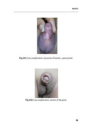 RESULTS
96
Fig [41] Late complication, recession of meatus , penoscrotal.
Fig [42] Late complication, torsion of the penis
 