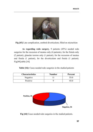 RESULTS
97
Fig [43] Late complication, urethral diverticulum, filled on micturition
As regarding redo surgery, 9 patients (45%) needed redo
surgeries for the recession of meatus only (4 patients), for the fistula only
(2 patient), glanular torsion only (1 patient), for the recession of meatus
and fistula (1 patient), for the diverticulum and fistula (1 patient).
Fig[44],table [16]
Table [16]: Cases needed redo surgeries in the studied patients
Characteristics Number Percent
Negative 11 55.0
Positive 9 45.0
Positive, 45
Negative, 55
Fig [44] Cases needed redo surgeries in the studied patients.
 