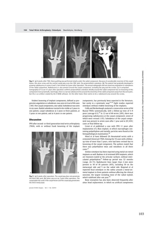   103	
  
	
  
	
   	
  
Evident loosening of implant components, deﬁned as pro-
gressive angulation or subsidence, was seen in 6 out of 44 cases
(14%): ﬁve carpal components, one radial. Subsidence was seen
in six cases: Radial subsidence started to be visible at 2 years in
one patient, carpal subsidence at 2 years in three patients, at
3 years in one patient, and at 4 years in one patient.
Discussion
PPO after second- or third-generation total wrist arthroplasty
(TWA), with or without frank loosening of the implant
components, has previously been reported in the literature,
but rarely in a systematic way.8–24
Eight studies reported
osteolysis without evident loosening of the implants.
Cobb and Beckenbaugh analyzed a consecutive series of 64
Biaxial TWAs systematically, with a follow-up time of 5–9
years (average 6.5).25
In 12 out of 46 wrists (26%), there was
progressing radiolucency at the carpal component, seven of
which were revised (15%). Subsidence of the carpal compo-
nent was present in seven cases after 1 year and in 20 (43%)
cases at ﬁnal follow-up.
Groot et al published a case with PPO 11 years after
implantation of a Biax implant, in which macrophages con-
taining polyethylene and metallic particles were found at the
histopathological examination.26
Ward et al have followed 24 rheumatoid wrists with a
cemented Universal I TWA. Among the 19 cases with a follow-
up time of more than 5 years, nine had been revised due to
loosening of the carpal component. The authors stated that
there was polyethylene wear and metallosis in all these
cases.21
Similar osteolysis has been reported using metal-on-metal
implants as well. Radmer et al reviewed APH implants, which
are titanium-coated at the articular surfaces, without inter-
calated polyethylene.8
Follow-up period was 52 months
(range, 24–73). Radiolucent lines larger than 2 mm were
present in 30 of 36 patients (83%), including 30 on the
metacarpal side and 5 on the radial side. Reigstad et al
reported focal osteolysis in the radius around a metal-on-
metal implant in three patients without affecting the clinical
outcome, the largest including most of the radial styloid,
which stabilized after one year.16
Bone resorption has also been observed frequently after
ulnar head replacement, in which no artiﬁcial components
Fig. 4 (a) 6 weeks after TWA. Bone grafting was performed ulnarly under the radial component. Because of considerable resection of the carpal
bones, the ulnar screw and the central carpal peg cross the CMC joint. No periprosthetic osteolysis. (b) The patient had gradually developed a
growing radiolucency in zones 4 and 5, here shown at 4 years after operation. The annual radiographs did not reveal any angulation or subsidence
of the radial component. Radiolucency is also present around the carpal component, including the peg and the screws. (c) A computed
tomography (CT) scan 4.5 years after operation conﬁrms periprosthetic osteolysis distally around the radial component but no loosening of this
component more proximally. Seemingly, there is a narrow radiolucent line around the extremity of the radial component away from the wrist joint,
but this is an artifact created by the O-MAR software. On the other hand, there seems to be a radiolucent area around the screws.
Fig. 5 (a) 6 weeks after operation. The carpal peg does not penetrate
the third CMC joint. (b) Same case as in a, 2 years after operation. The
carpal plate has sunk in the carpal bones and the carpal peg penetrates
the third metacarpal.
Journal of Wrist Surgery Vol. 3 No. 2/2014
Total Wrist Arthroplasty: Osteolysis Boeckstyns, Herzberg104
Thisdocumentwasdownloadedforpersonaluseonly.Unauthorizeddistributionisstrictlyprohibited.
 