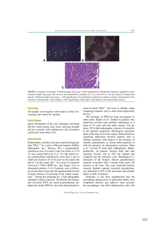  111	
  
	
  
Bacteriology
All samples were negative with respect to direct mi-
croscopy and culture for bacteria.
Clinical ﬁndings
QuickeDisabilities of the Arm, Shoulder, and Hand
and the visual analog scale scores and grip strength
did not correlate with radiolucency (all correlation
coefﬁcients lower than 0.10).
DISCUSSION
Periprosthetic osteolysis has been reported frequently
after TWA.16
In a series of Biaxial implants (DePuy
Orthopedics, Inc., Warsaw, IN), a periprosthetic
radiolucent zone of at least 2 mm was found in 12 of
32 cases (mean follow-up, 6 y).8
In a Re-motion se-
ries, periprosthetic radiolucency more than 2 mm in
width was found in 16 of 44 cases on the radial side
and in 7 on the carpal side.17
In a series of cemented
Universal I TWA (KMI Inc., San Diego, CA) in
rheumatoid patients, 9 of 19 patients seen at follow-
up of more than 5 years after the operation had received
revisions because of loosening of the carpal compo-
nent.12
Among the remaining ten, 3 had radiographic
subsidence and/or osteolysis. The Biaxial, Re-motion,
and Universal TWA are metal-on-polyethylene im-
plants but similar PPO has also been demonstrated in
metal-on-metal TWA18
and even in metallic single
component implants such as ulnar head replacement
devices.19
The histology of PPO has been investigated in
other joints. Kepler et al20
studied 52 patients who
underwent revision total shoulder arthroplasty at a
mean of 4.5 years after the index surgery. Ten pa-
tients (19%) had radiographic evidence of osteolysis
at the glenoid component. Histological specimens
taken at the time of revision surgery demonstrated no
signiﬁcant differences between patients with or
without osteolysis with respect to the presence of
metallic, polyethylene, or cement debris particles or
with the presence of inﬂammatory reactions. Dalat
et al21
revised 25 total ankle arthroplasties. Radio-
graphically, all patients showed tibial and talar
osteolytic lesions, and in 25% the implant had
collapsed into the osteolytic cysts. Histological ex-
amination of the biopsies showed granulomatous
response associated with a foreign body giant cell
reaction in all cases. The cysts contained necrotic
material. Implant material, primarily polyethylene,
was identiﬁed in 95% of the specimens and metallic
debris in 60% of patients.
Generally, it has been hypothesized that the
macrophage phagocytosis of particulate debris from
component abrasive and adhesive wear activates
the macrophages and other inﬂammatory cells with
FIGURE 4: Examples of histology. A Polarized light microscopy (x200 magniﬁcation). Polyethylene fragments engulfed by multi-
nucleated foreign body giant cells (arrows), semi-quantitatively estimated as 2 on a scale of 0 to 3 for the amount of foreign body
particles. B Polarized light microscopy (Â 100 magniﬁcation). No polyethylene fragments or particles could be demonstrated in this
specimen. C Hematoxylineeosin staining (Â 200 magniﬁcation). Only sparse metal particles were demonstrable (arrows).
WEAR PARTICLES AND OSTEOLYSIS AFTER TOTAL WRIST ARTHROPLASTY 2401
J Hand Surg Am. r Vol. 39, December 2014
 