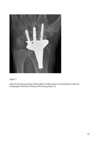   41	
  
	
  
	
  
Figure	
  7	
  
	
  
Spots	
  for	
  the	
  measurement	
  of	
  the	
  width	
  of	
  radiolucency	
  on	
  serial	
  postero-­‐anterior	
  
radiographs.	
  (Courtesy	
  Thieme/J	
  Wrist	
  Surg,	
  Paper	
  V).	
  
	
   	
  
 