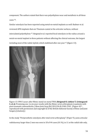   54	
  
component.	
  The	
  authors	
  stated	
  that	
  there	
  was	
  polyethylene	
  wear	
  and	
  metallosis	
  in	
  all	
  these	
  
cases	
  38.	
  	
  
Similar	
  osteolysis	
  has	
  been	
  reported	
  using	
  metal-­‐on-­‐metal	
  implants	
  as	
  well.	
  Radmer	
  et	
  al.	
  
reviewed	
  APH-­‐implants	
  that	
  are	
  Titanium-­‐coated	
  at	
  the	
  articular	
  surfaces,	
  without	
  
intercalated	
  polyethylene	
  39.	
  Reigstad	
  et	
  al.	
  reported	
  focal	
  osteolysis	
  in	
  the	
  radius	
  around	
  a	
  
metal-­‐on-­‐metal	
  implant	
  in	
  three	
  patients	
  without	
  affecting	
  the	
  clinical	
  outcome,	
  the	
  largest	
  
including	
  most	
  of	
  the	
  radial	
  styloid,	
  which	
  stabilized	
  after	
  one	
  year	
  62	
  (figure	
  13).	
  	
  
	
  
	
  
Figure	
  13:	
  PPO	
  3	
  years	
  after	
  Motec	
  metal-­‐on-­‐metal	
  TWA	
  (Reigstad	
  O,	
  Lütken	
  T,	
  Grimsgaard	
  
C,	
  et	
  al.	
  Promising	
  one-­‐	
  to	
  six-­‐year	
  results	
  with	
  the	
  Motec	
  wrist	
  arthroplasty	
  in	
  patients	
  with	
  
post-­‐traumatic	
  osteoarthritis.	
  J	
  Bone	
  Joint	
  Surg	
  [Br]	
  2012;94-­‐B:1540-­‐1545.	
  	
  (Figure	
  4)62	
  ,	
  
reproduced	
  with	
  permission	
  and	
  copyright	
  ©	
  of	
  the	
  British	
  Editorial	
  Society	
  of	
  Bone	
  and	
  Joint	
  
Surgery	
  [citation].)	
  
	
  
In	
  the	
  study	
  “Periprosthetic	
  osteolysis	
  after	
  total	
  wrist	
  arthroplasty”	
  (Paper	
  V),	
  juxta-­‐articular	
  
radiolucency	
  larger	
  than	
  2	
  mm	
  was	
  seen	
  in	
  18	
  of	
  44	
  cases	
  (41	
  %),	
  in	
  11	
  at	
  the	
  radial	
  side	
  only,	
  
 